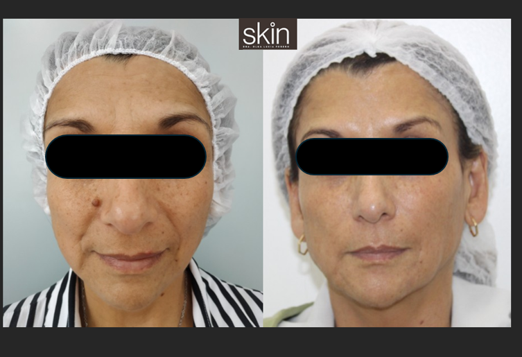 HIFU (High Intensity Focused Ultrasound) - Lift-!N Plus